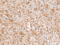 Immunohistochemistry of paraffin-embedded Human liver cancer tissue using RTKN2 Polyclonal Antibody at dilution of 1:70 (×200)