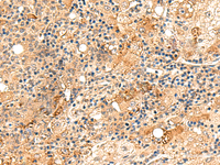 Immunohistochemistry of paraffin-embedded Human liver cancer tissue using REG1B Polyclonal Antibody at dilution of 1:60 (×200)