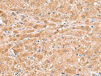 Immunohistochemistry of paraffin-embedded Human liver cancer tissue using HMGCLL1 Polyclonal Antibody at dilution of 1:70 (×200)