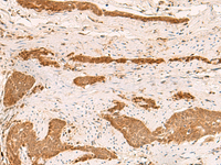 Immunohistochemistry of paraffin-embedded Human liver cancer tissue using ZFYVE27 Polyclonal Antibody at dilution of 1:50 (×200)