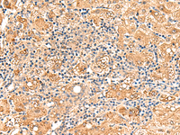 Immunohistochemistry of paraffin-embedded Human liver cancer tissue using GPD1L Polyclonal Antibody at dilution of 1:60 (×200)