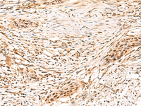 Immunohistochemistry of paraffin-embedded Human esophagus cancer tissue using SETMAR Polyclonal Antibody at dilution of 1:100 (×200)