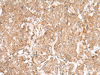 Immunohistochemistry of paraffin-embedded Human lung cancer tissue using GMPPB Polyclonal Antibody at dilution of 1:50 (×200)