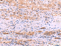 Immunohistochemistry of paraffin-embedded Human liver cancer tissue using DHPS Polyclonal Antibody at dilution of 1:55 (×200)