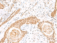 Immunohistochemistry of paraffin-embedded Human esophagus cancer tissue using ELF3 Polyclonal Antibody at dilution of 1:60 (×200)