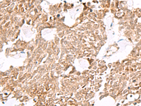 Immunohistochemistry of paraffin-embedded Human lung cancer tissue using ELF3 Polyclonal Antibody at dilution of 1:60 (×200)