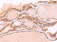 Immunohistochemistry of paraffin-embedded Human thyroid cancer tissue using RABEPK Polyclonal Antibody at dilution of 1:65 (×200)