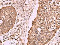 Immunohistochemistry of paraffin-embedded Human esophagus cancer tissue using PER3 Polyclonal Antibody at dilution of 1:70 (×200)