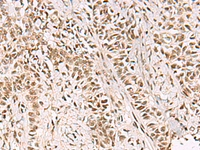 Immunohistochemistry of paraffin-embedded Human ovarian cancer tissue using GABPB1 Polyclonal Antibody at dilution of 1:55 (×200)