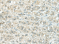 Immunohistochemistry of paraffin-embedded Human liver cancer tissue using TENT5C Polyclonal Antibody at dilution of 1:110 (×200)