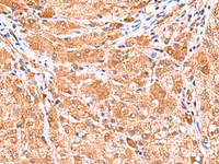 Immunohistochemistry of paraffin-embedded Human liver cancer tissue using PHKG2 Polyclonal Antibody at dilution of 1:60 (×200)