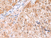 Immunohistochemistry of paraffin-embedded Human liver cancer tissue using FDFT1 Polyclonal Antibody at dilution of 1:75 (×200)