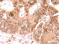 Immunohistochemistry of paraffin-embedded Human colorectal cancer tissue using FDPS Polyclonal Antibody at dilution of 1:60 (×200)