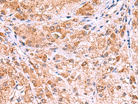 Immunohistochemistry of paraffin-embedded Human liver cancer tissue using UXS1 Polyclonal Antibody at dilution of 1:60 (×200)