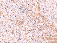 Immunohistochemistry of paraffin-embedded Human liver cancer tissue using RIC8A Polyclonal Antibody at dilution of 1:80 (×200)