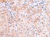 Immunohistochemistry of paraffin-embedded Human liver cancer tissue using SMPD2 Polyclonal Antibody at dilution of 1:70 (×200)