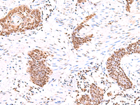 Immunohistochemistry of paraffin-embedded Human esophagus cancer tissue using ACTL6B Polyclonal Antibody at dilution of 1:55 (×200)