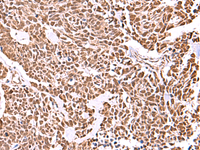 Immunohistochemistry of paraffin-embedded Human lung cancer tissue using RCOR3 Polyclonal Antibody at dilution of 1:55 (×200)