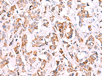 Immunohistochemistry of paraffin-embedded Human breast cancer tissue using SIGLEC6 Polyclonal Antibody at dilution of 1:50 (×200)