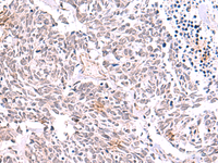 Immunohistochemistry of paraffin-embedded Human lung cancer tissue using TRMT12 Polyclonal Antibody at dilution of 1:85 (×200)