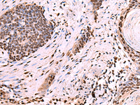 Immunohistochemistry of paraffin-embedded Human esophagus cancer tissue using NASP Polyclonal Antibody at dilution of 1:60 (×200)