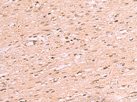 Immunohistochemistry of paraffin-embedded Human colorectal cancer tissue using RRP8 Polyclonal Antibody at dilution of 1:70 (×200)
