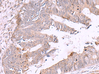 Immunohistochemistry of paraffin-embedded Human colorectal cancer tissue using ZSWIM1 Polyclonal Antibody at dilution of 1:55 (×200)