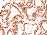 Immunohistochemistry of paraffin-embedded Human thyroid cancer tissue using TOR1AIP1 Polyclonal Antibody at dilution of 1:60 (×200)