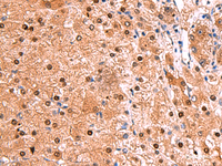 Immunohistochemistry of paraffin-embedded Human liver cancer tissue using TSEN2 Polyclonal Antibody at dilution of 1:80 (×200)