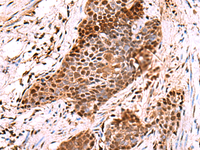 Immunohistochemistry of paraffin-embedded Human esophagus cancer tissue using POLD2 Polyclonal Antibody at dilution of 1:60 (×200)