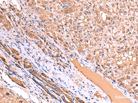Immunohistochemistry of paraffin-embedded Human liver cancer tissue using TTC38 Polyclonal Antibody at dilution of 1:85 (×200)