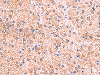 Immunohistochemistry of paraffin-embedded Human liver cancer tissue using ZNF256 Polyclonal Antibody at dilution of 1:70 (×200)