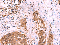 Immunohistochemistry of paraffin-embedded Human esophagus cancer tissue using KATNAL1 Polyclonal Antibody at dilution of 1:80 (×200)