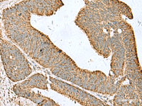 Immunohistochemistry of paraffin-embedded Human colorectal cancer tissue using CDC20 Polyclonal Antibody at dilution of 1:50 (×200)