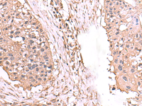 Immunohistochemistry of paraffin-embedded Human esophagus cancer tissue using AHCYL1 Polyclonal Antibody at dilution of 1:65 (×200)