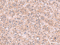 Immunohistochemistry of paraffin-embedded Human liver cancer tissue using KPNA2 Polyclonal Antibody at dilution of 1:60 (×200)