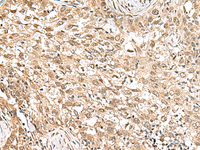 Immunohistochemistry of paraffin-embedded Human esophagus cancer tissue using RPS6KA5 Polyclonal Antibody at dilution of 1:160 (×200)