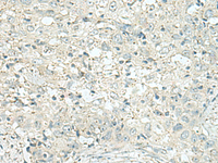 Immunohistochemistry of paraffin-embedded Human esophagus cancer tissue using DENND6A Polyclonal Antibody at dilution of 1:120 (×200)