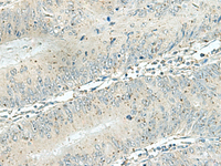 Immunohistochemistry of paraffin-embedded Human colorectal cancer tissue using DENND6A Polyclonal Antibody at dilution of 1:120 (×200)