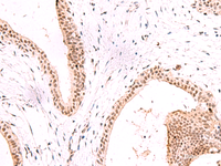 Immunohistochemistry of paraffin-embedded Human breast cancer tissue using CBFA2T2 Polyclonal Antibody at dilution of 1:60 (×200)