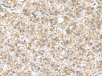Immunohistochemistry of paraffin-embedded Human liver cancer tissue using PAPSS2 Polyclonal Antibody at dilution of 1:95 (×200)