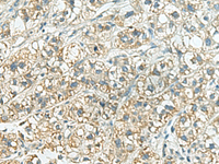 Immunohistochemistry of paraffin-embedded Human liver cancer tissue using SORBS2 Polyclonal Antibody at dilution of 1:160 (×200)