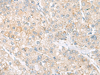 Immunohistochemistry of paraffin-embedded Human liver cancer tissue using FARP2 Polyclonal Antibody at dilution of 1:55 (×200)