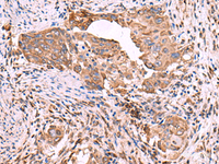 Immunohistochemistry of paraffin-embedded Human cervical cancer tissue using EEF1D Polyclonal Antibody at dilution of 1:55 (×200)