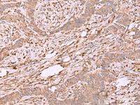 Immunohistochemistry of paraffin-embedded Human ovarian cancer tissue using EEF1D Polyclonal Antibody at dilution of 1:55 (×200)