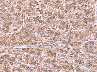 Immunohistochemistry of paraffin-embedded Human liver cancer tissue using GUSB Polyclonal Antibody at dilution of 1:75 (×200)