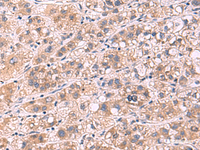 Immunohistochemistry of paraffin-embedded Human liver cancer tissue using PPEF1 Polyclonal Antibody at dilution of 1:90 (×200)