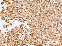 Immunohistochemistry of paraffin-embedded Human lung cancer tissue using NVL Polyclonal Antibody at dilution of 1:70 (×200)