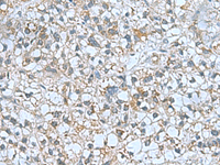 Immunohistochemistry of paraffin-embedded Human liver cancer tissue using CNTN4 Polyclonal Antibody at dilution of 1:60 (×200)