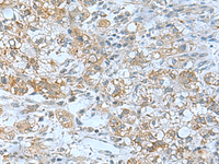 Immunohistochemistry of paraffin-embedded Human liver cancer tissue using TSGA10 Polyclonal Antibody at dilution of 1:50 (×200)